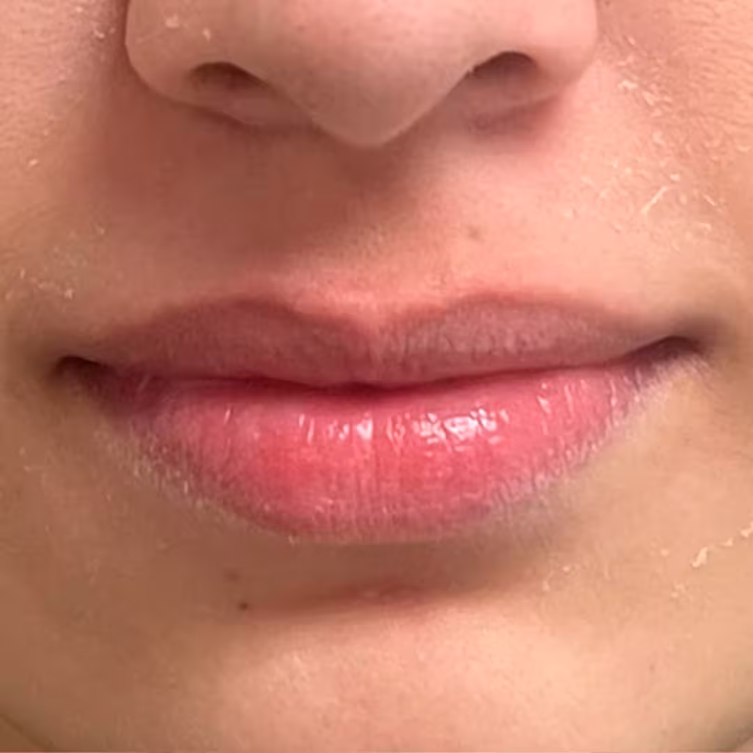 Antes