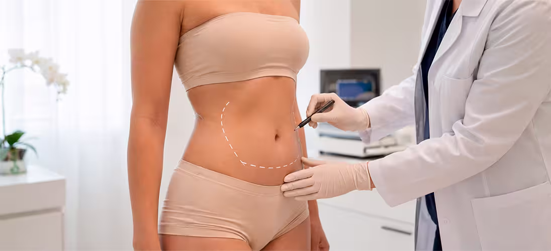 liposucción abdomen